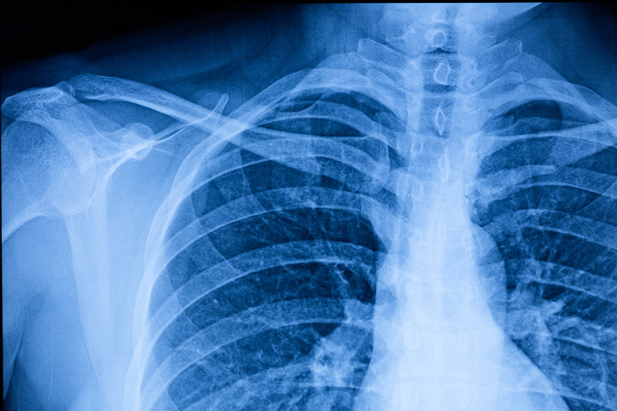 xray of upper chest